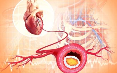Americans & Atherosclerosis: The Early Symptoms You Can’t Ignore